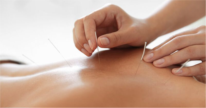 Acupuncture 1