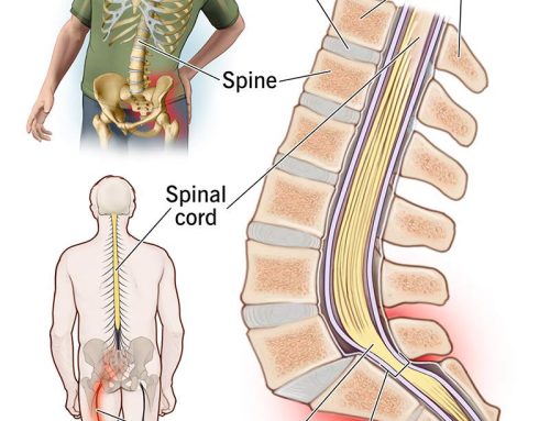 Sciatica: 3 ways to finding relief